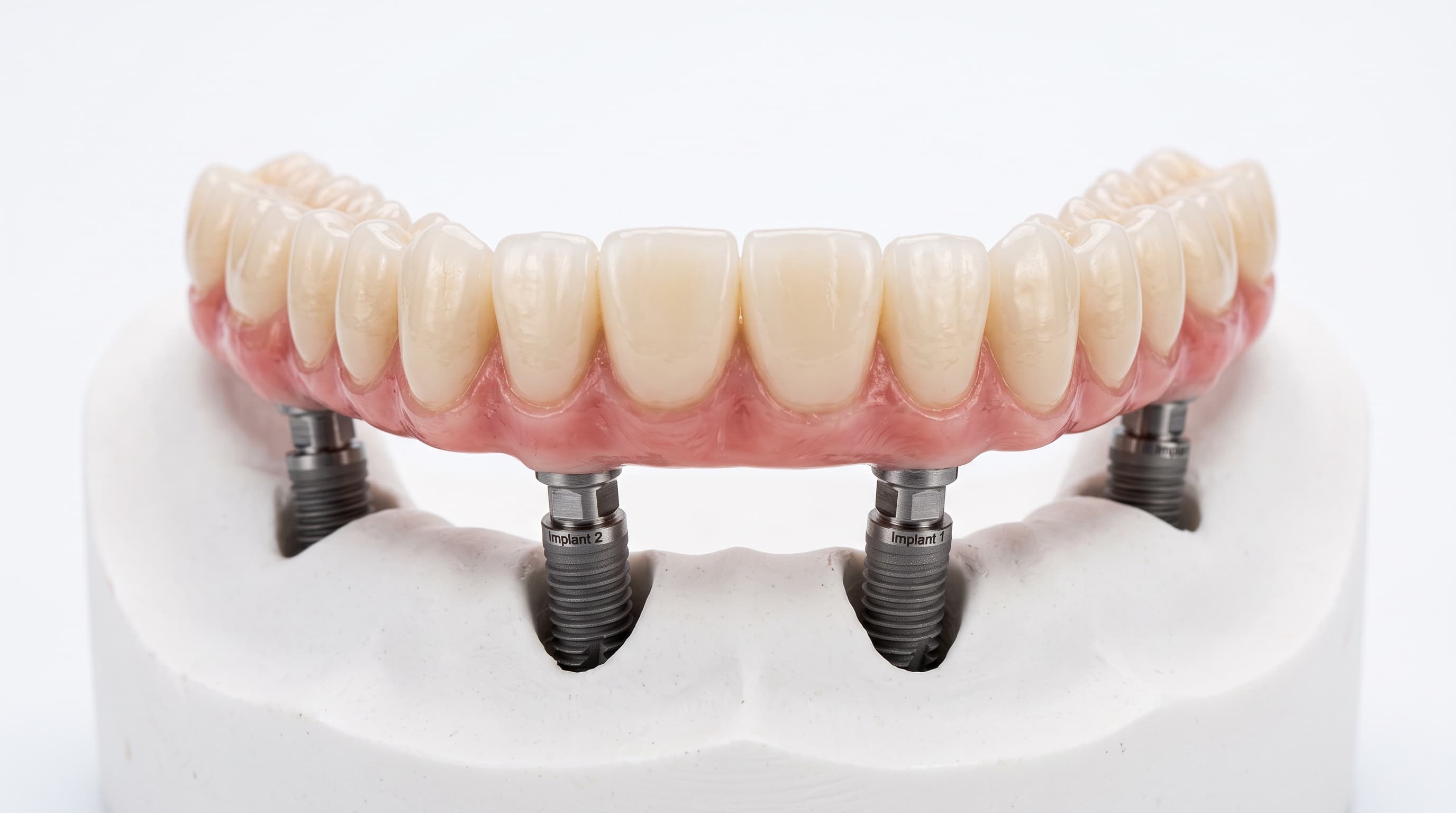 Full Arch Implants at Kaleidoscope Dental Specialists, Marylebone London