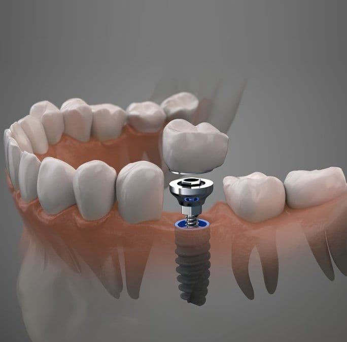 Dental Implants at Kaleidoscope Dental Specialists, Marylebone London